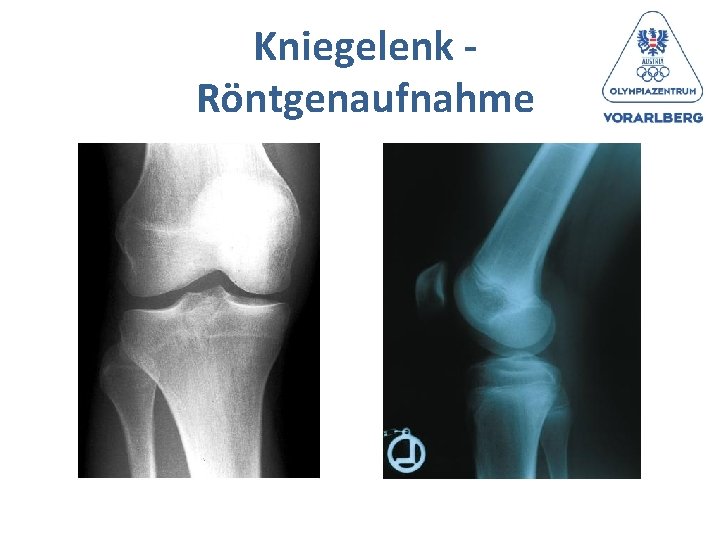 Kniegelenk - Röntgenaufnahme 