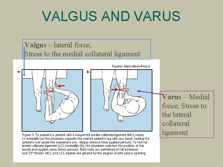 VALGUS AND VARUS Valgus – lateral force; Stress to the medial collateral ligament Varus