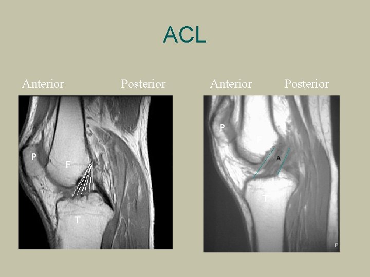 ACL Anterior Posterior P F T T 