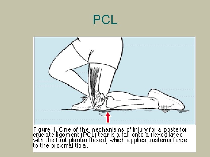 PCL 