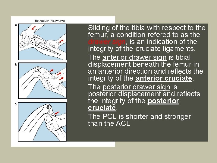  • • Sliding of the tibia with respect to the femur, a condition