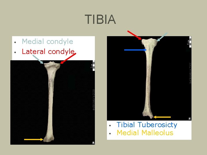 TIBIA • • Medial condyle Lateral condyle • • Tibial Tuberosicty Medial Malleolus 