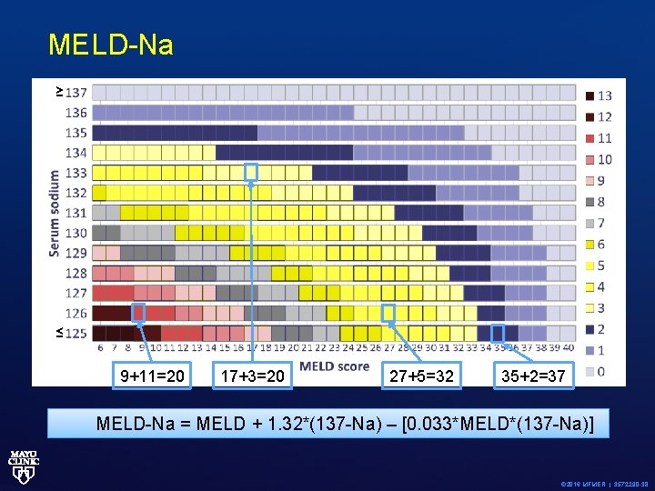 MELD-Na ≥ ≤ 9+11=20 17+3=20 27+5=32 35+2=37 MELD-Na = MELD + 1. 32*(137 -Na)