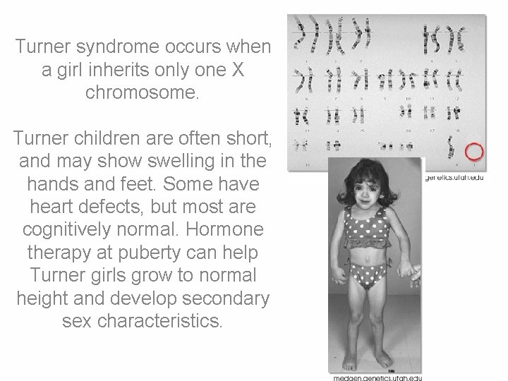 Turner syndrome occurs when a girl inherits only one X chromosome. Turner children are