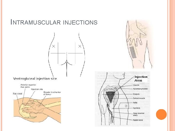 INTRAMUSCULAR INJECTIONS 