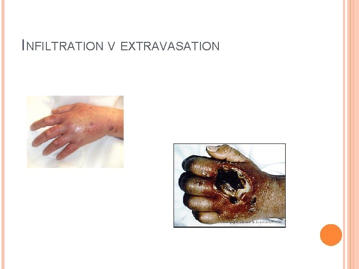 INFILTRATION V EXTRAVASATION 