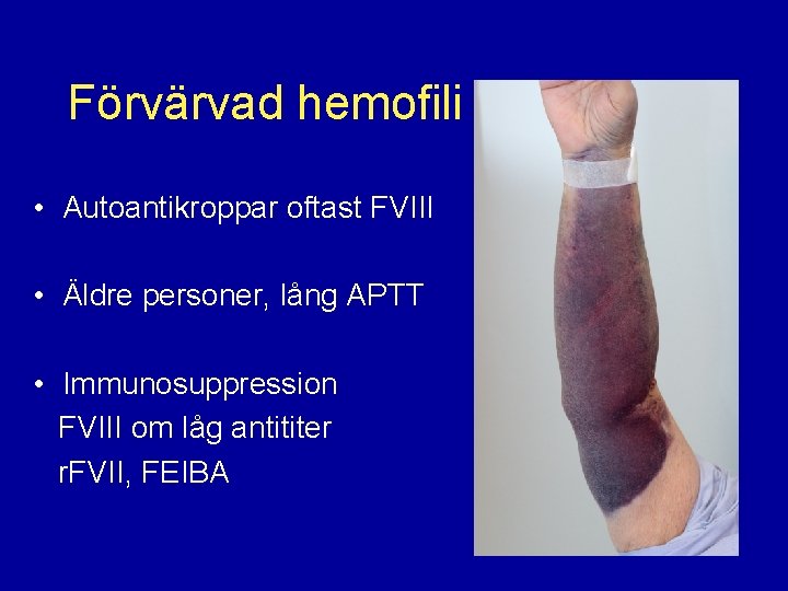 Förvärvad hemofili • Autoantikroppar oftast FVIII • Äldre personer, lång APTT • Immunosuppression FVIII