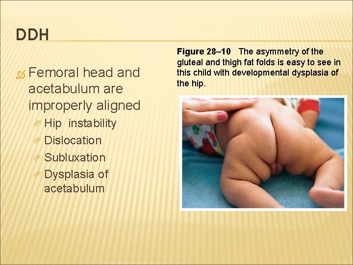 DDH Femoral head and acetabulum are improperly aligned Hip instability Dislocation Subluxation Dysplasia of