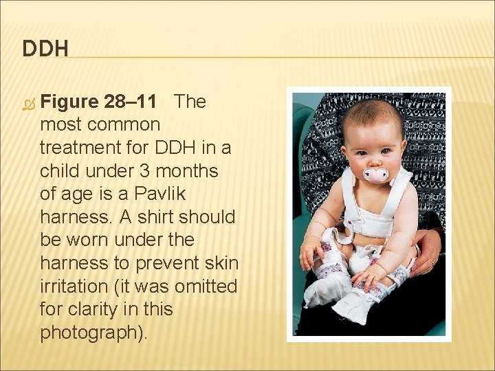 DDH Figure 28– 11 The most common treatment for DDH in a child under