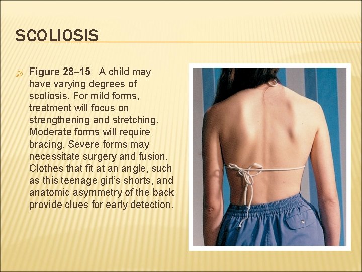 SCOLIOSIS Figure 28– 15 A child may have varying degrees of scoliosis. For mild