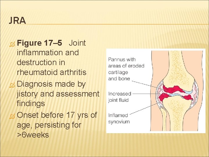 JRA Figure 17– 5 Joint inflammation and destruction in rheumatoid arthritis Diagnosis made by