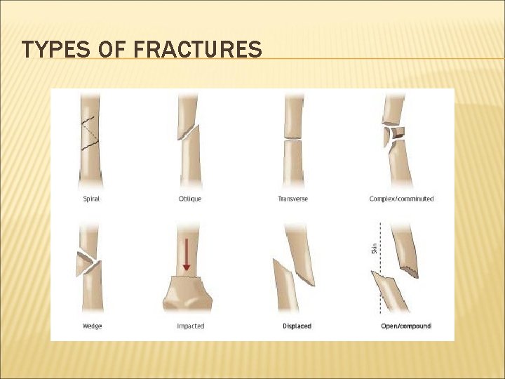 TYPES OF FRACTURES 