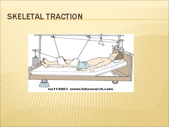 SKELETAL TRACTION 