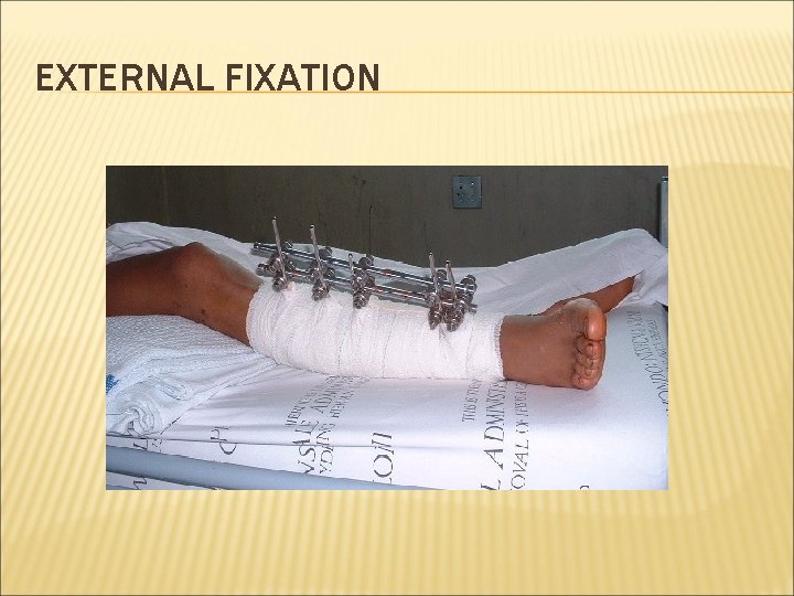 EXTERNAL FIXATION 