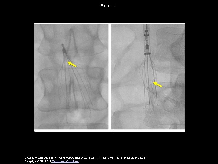 Figure 1 Journal of Vascular and Interventional Radiology 2015 26111 -115. e 1 DOI: