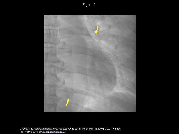 Figure 2 Journal of Vascular and Interventional Radiology 2015 26111 -115. e 1 DOI: