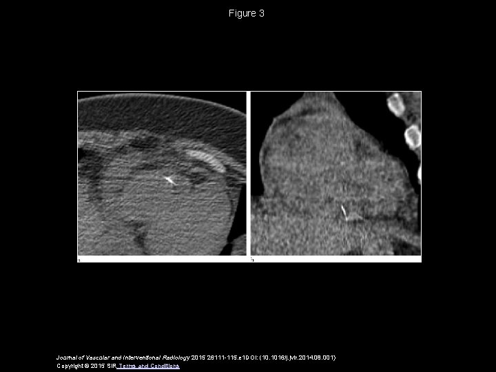 Figure 3 Journal of Vascular and Interventional Radiology 2015 26111 -115. e 1 DOI: