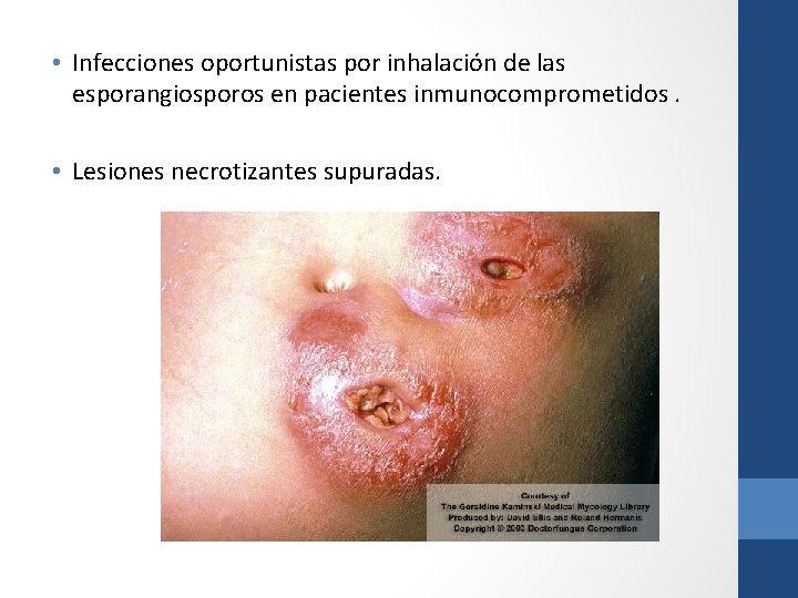  • Infecciones oportunistas por inhalación de las esporangiosporos en pacientes inmunocomprometidos. • Lesiones