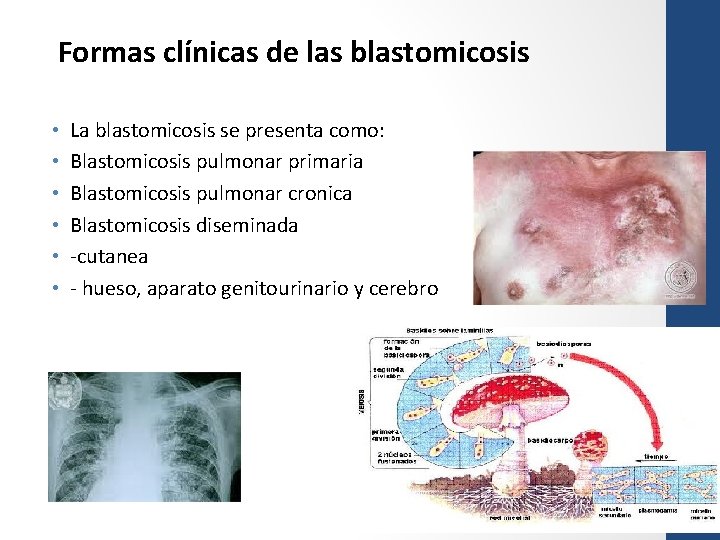 Formas clínicas de las blastomicosis • • • La blastomicosis se presenta como: Blastomicosis