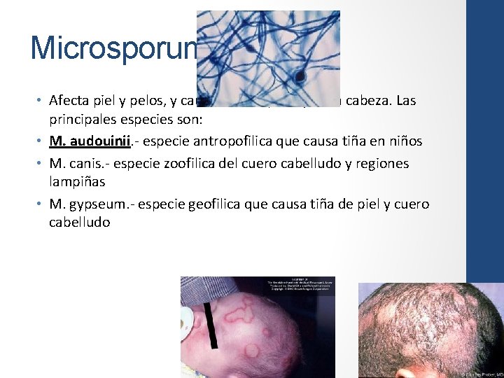 Microsporum • Afecta piel y pelos, y causa tiña corporis y de la cabeza.