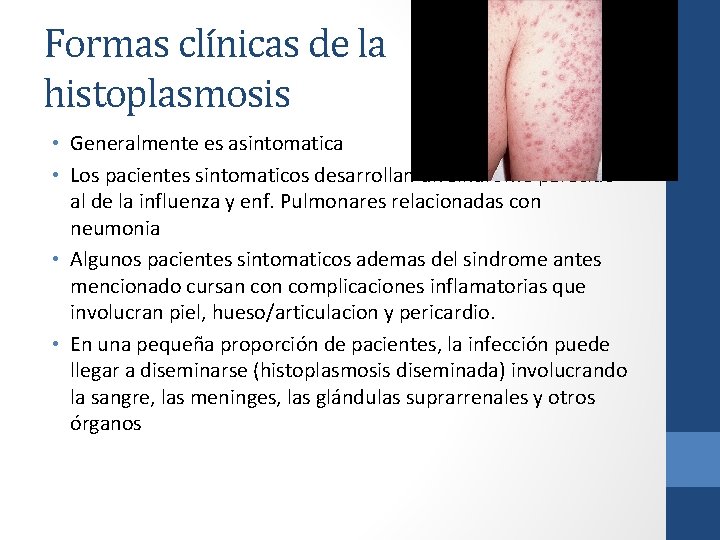 Formas clínicas de la histoplasmosis • Generalmente es asintomatica • Los pacientes sintomaticos desarrollan