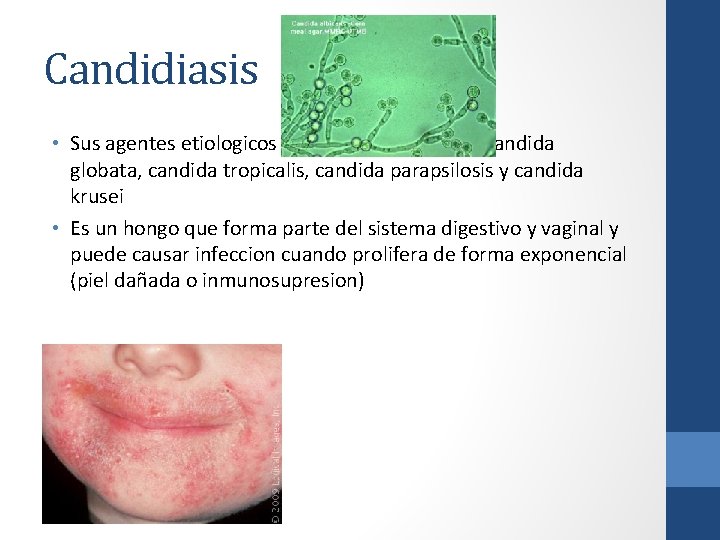 Candidiasis • Sus agentes etiologicos son: Candida albicans, candida globata, candida tropicalis, candida parapsilosis