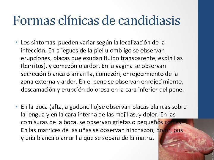 Formas clínicas de candidiasis • Los síntomas pueden variar según la localización de la