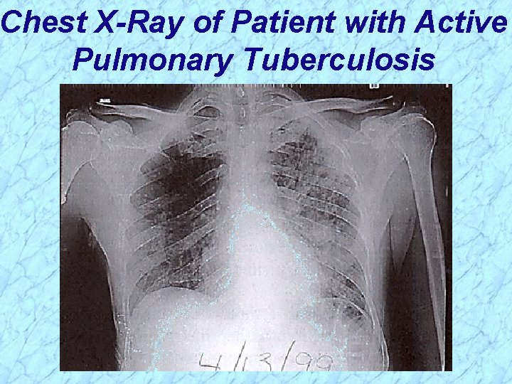 Chest X-Ray of Patient with Active Pulmonary Tuberculosis 