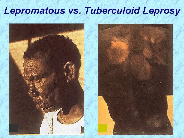 Lepromatous vs. Tuberculoid Leprosy 
