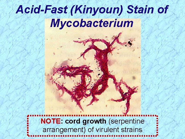 Acid-Fast (Kinyoun) Stain of Mycobacterium NOTE: cord growth (serpentine arrangement) of virulent strains 