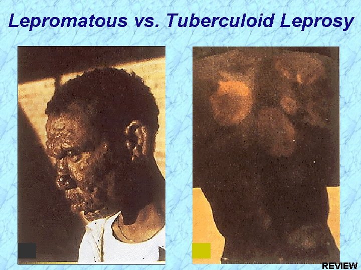 Lepromatous vs. Tuberculoid Leprosy REVIEW 
