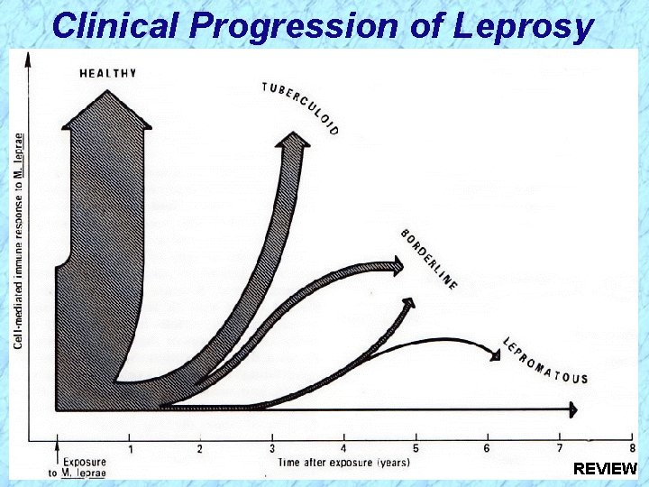 Clinical Progression of Leprosy REVIEW 