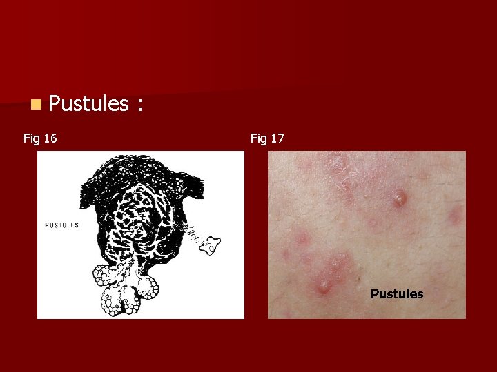 n Pustules : Fig 16 Fig 17 Pustules 