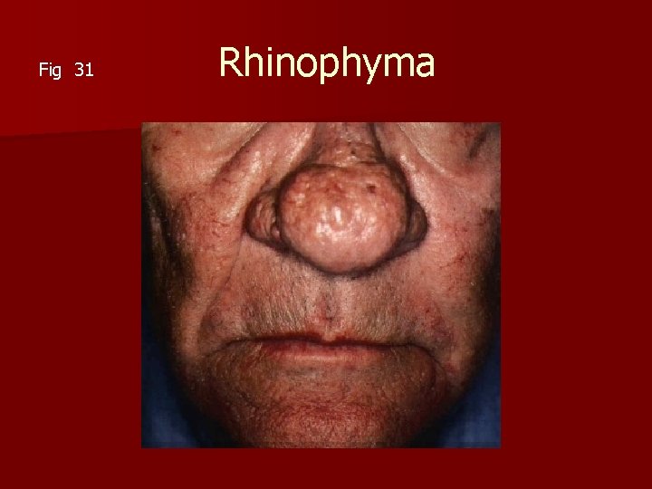 Rhinophyma Fig 31 