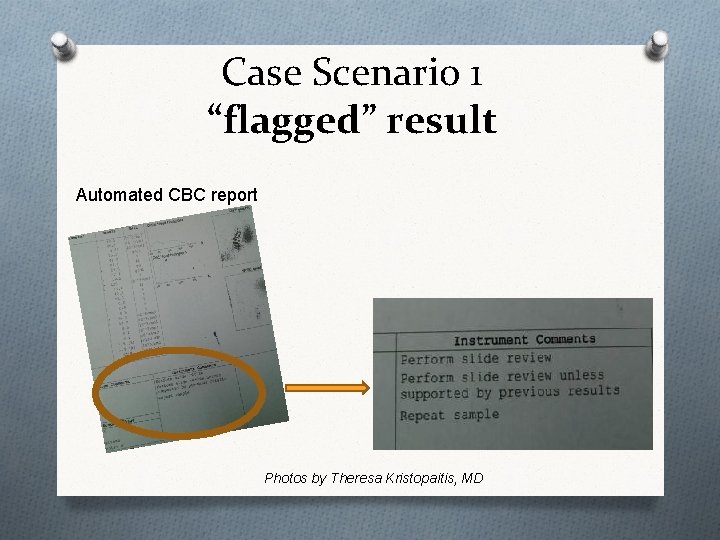 Case Scenario 1 “flagged” result Automated CBC report Photos by Theresa Kristopaitis, MD 