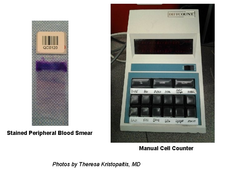 Stained Peripheral Blood Smear Manual Cell Counter Photos by Theresa Kristopaitis, MD 
