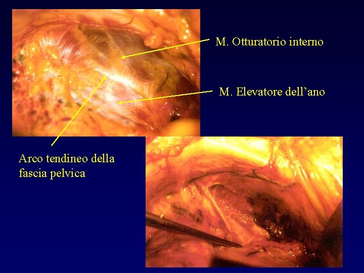 M. Otturatorio interno M. Elevatore dell’ano Arco tendineo della fascia pelvica 