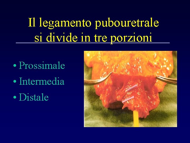 Il legamento pubouretrale si divide in tre porzioni • Prossimale • Intermedia • Distale