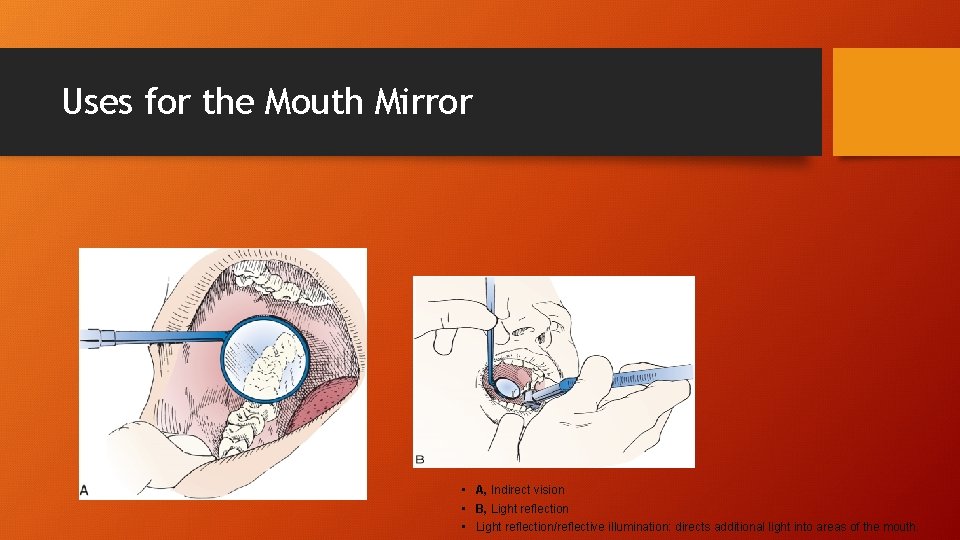 Uses for the Mouth Mirror • A, Indirect vision • B, Light reflection • Uses for the Mouth Mirror • A, Indirect vision • B, Light reflection •