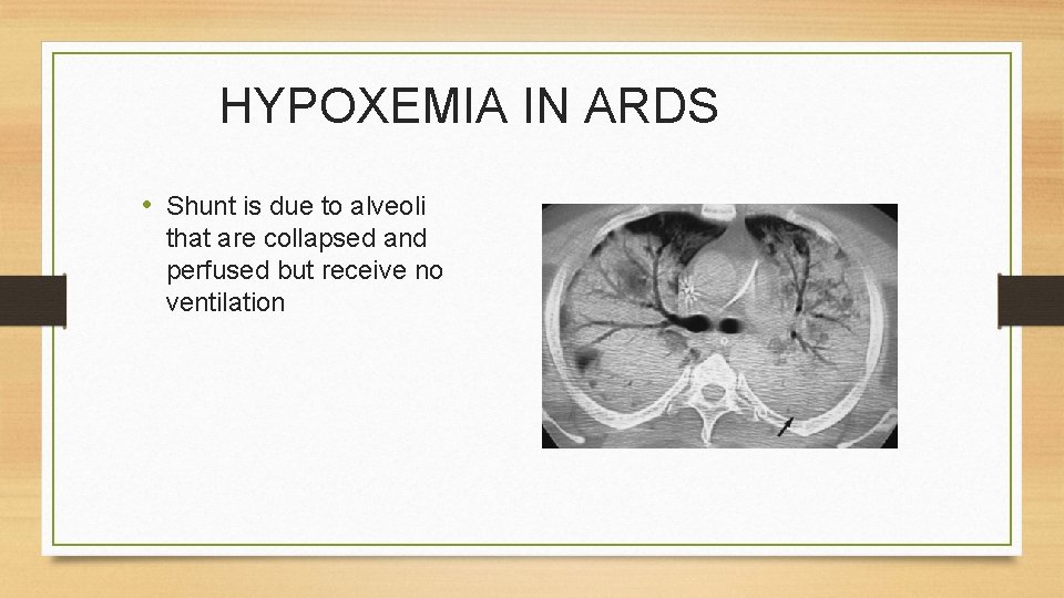 HYPOXEMIA IN ARDS • Shunt is due to alveoli that are collapsed and perfused