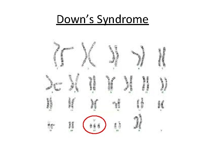 Down’s Syndrome 