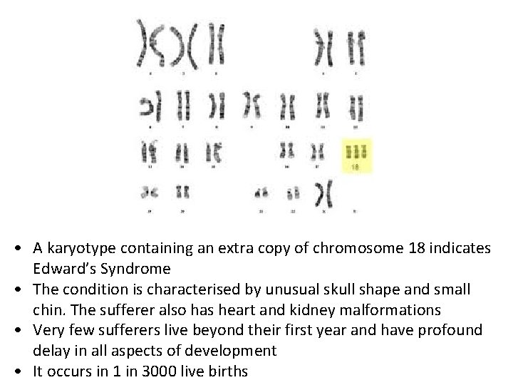 • A karyotype containing an extra copy of chromosome 18 indicates Edward’s Syndrome