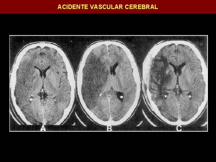 ACIDENTE VASCULAR CEREBRAL 