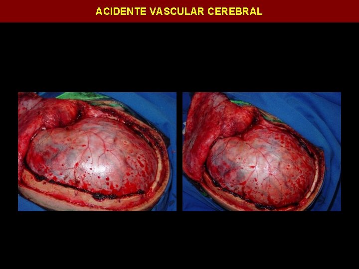 ACIDENTE VASCULAR CEREBRAL 