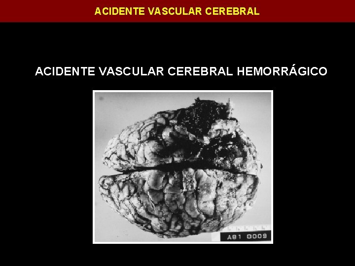 ACIDENTE VASCULAR CEREBRAL HEMORRÁGICO 