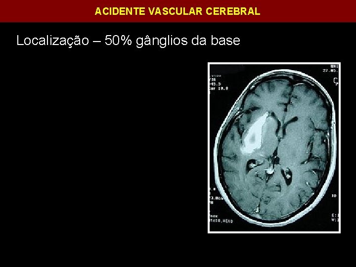 ACIDENTE VASCULAR CEREBRAL Localização – 50% gânglios da base 