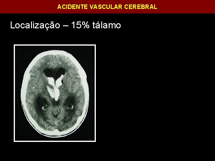 ACIDENTE VASCULAR CEREBRAL Localização – 15% tálamo 