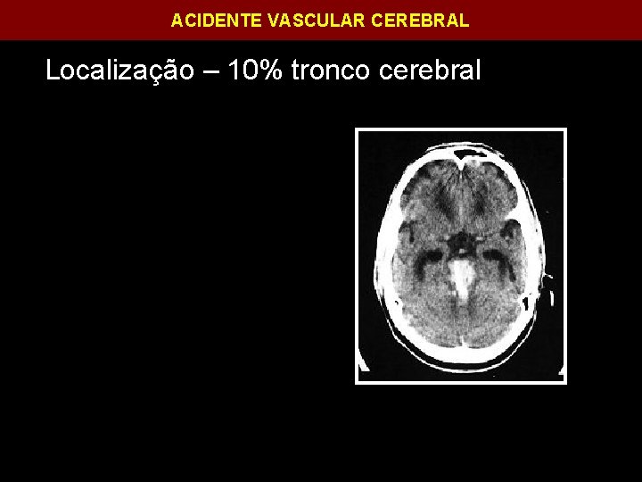 ACIDENTE VASCULAR CEREBRAL Localização – 10% tronco cerebral 
