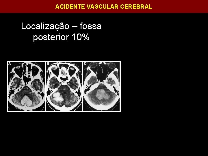 ACIDENTE VASCULAR CEREBRAL Localização – fossa posterior 10% 