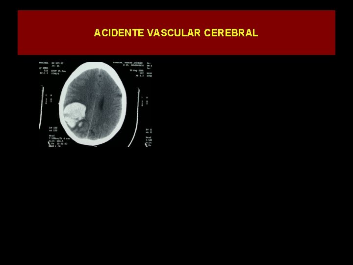 ACIDENTE VASCULAR CEREBRAL 